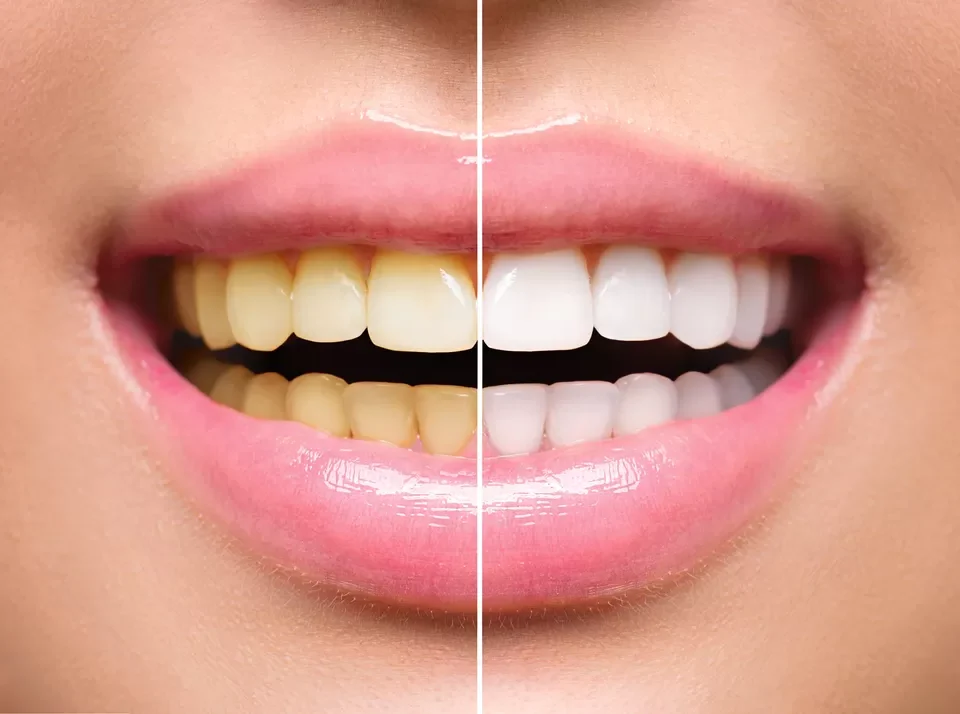 The Benefits of Teeth Whitening in Cosmetic Dentistry