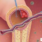 The Connection Between Diabetes and Vascular Health