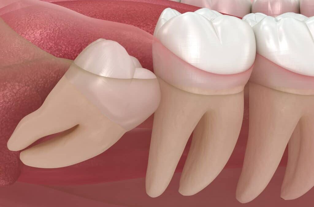 The Truth Behind Wisdom Teeth