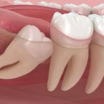 The Truth Behind Wisdom Teeth