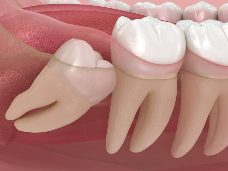 The Truth Behind Wisdom Teeth