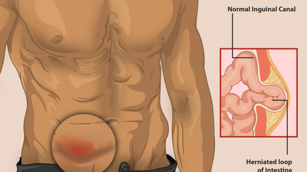 Understanding Different Types of Hernias and Their Symptoms