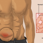 Understanding Different Types of Hernias and Their Symptoms