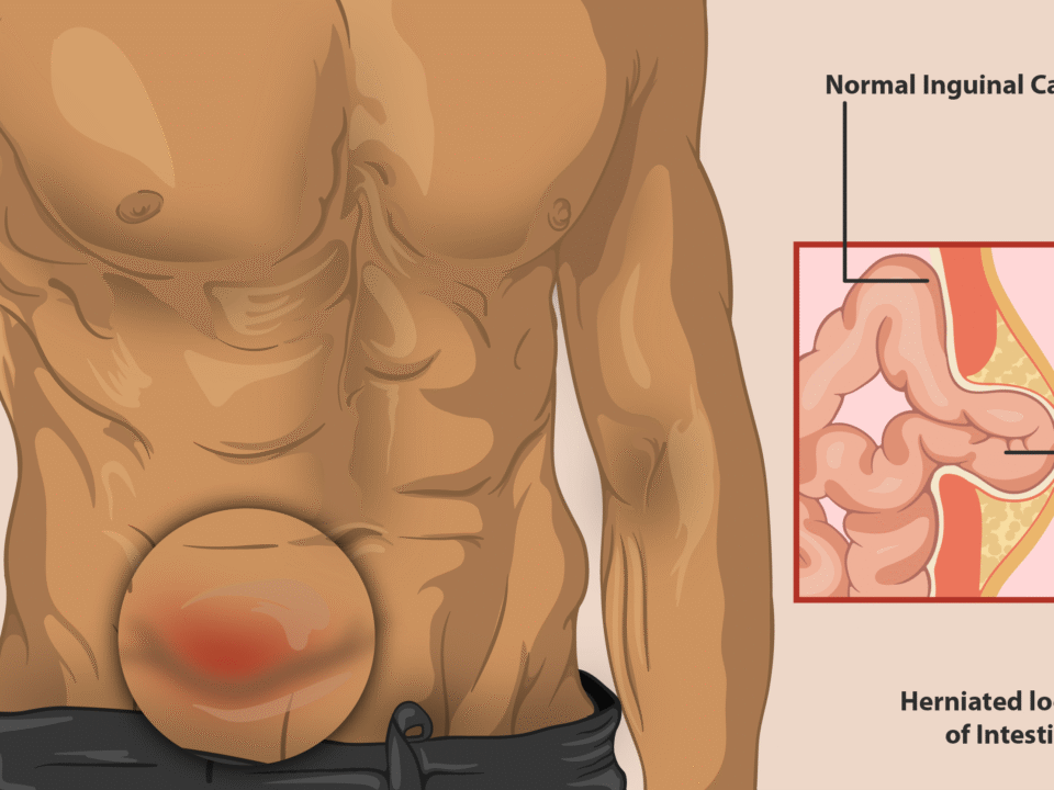 Understanding Different Types of Hernias and Their Symptoms