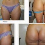 Understanding What to Expect During Liposuction