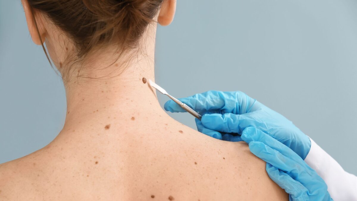 Understanding the Different Types of Skin Cancer and Their Symptoms