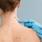 Understanding the Different Types of Skin Cancer and Their Symptoms
