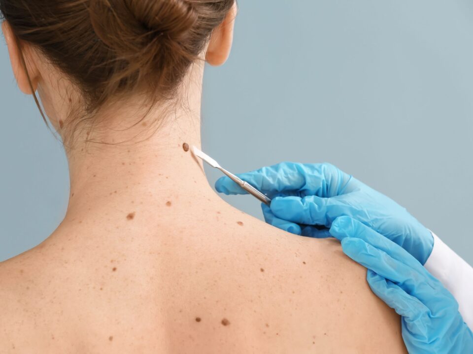 Understanding the Different Types of Skin Cancer and Their Symptoms
