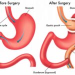Understanding the Factors That Affect the Success of Bariatric Surgery