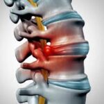 Understanding the Long-Term Implications of a Herniated Disc