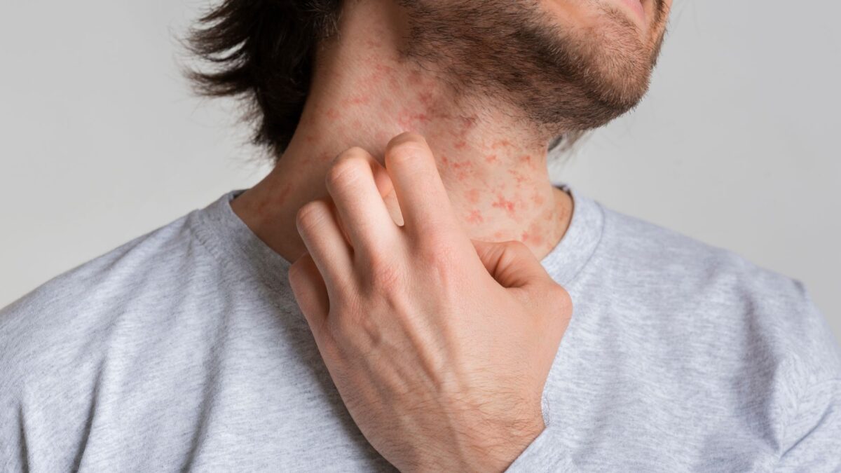 What Is Eczema and How Do I Treat It?