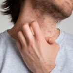 What Is Eczema and How Do I Treat It?