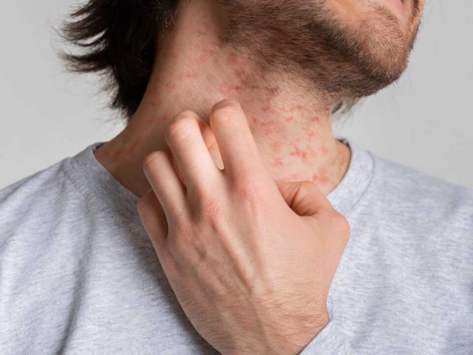 What Is Eczema and How Do I Treat It?