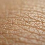 Why Get Mohs Micrographic Surgery for Treating Skin Cancers