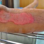 Wound Care Techniques and Healing Strategies for Various Injuries